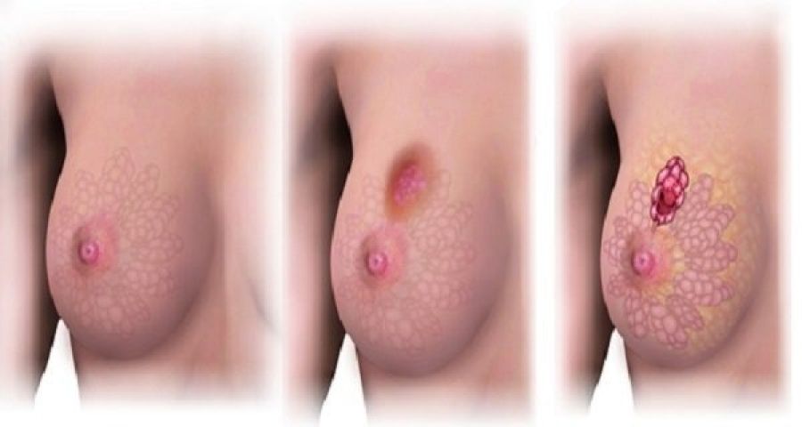 Octobre rose : Mise en place d’un projet de construction d’un centre en oncologie